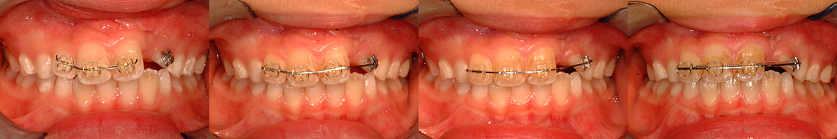 口唇口蓋裂の治療例（Ⅰ期治療）　左側口唇顎裂に起因する上顎前歯部叢生　骨移植後の動的治療中　口腔内